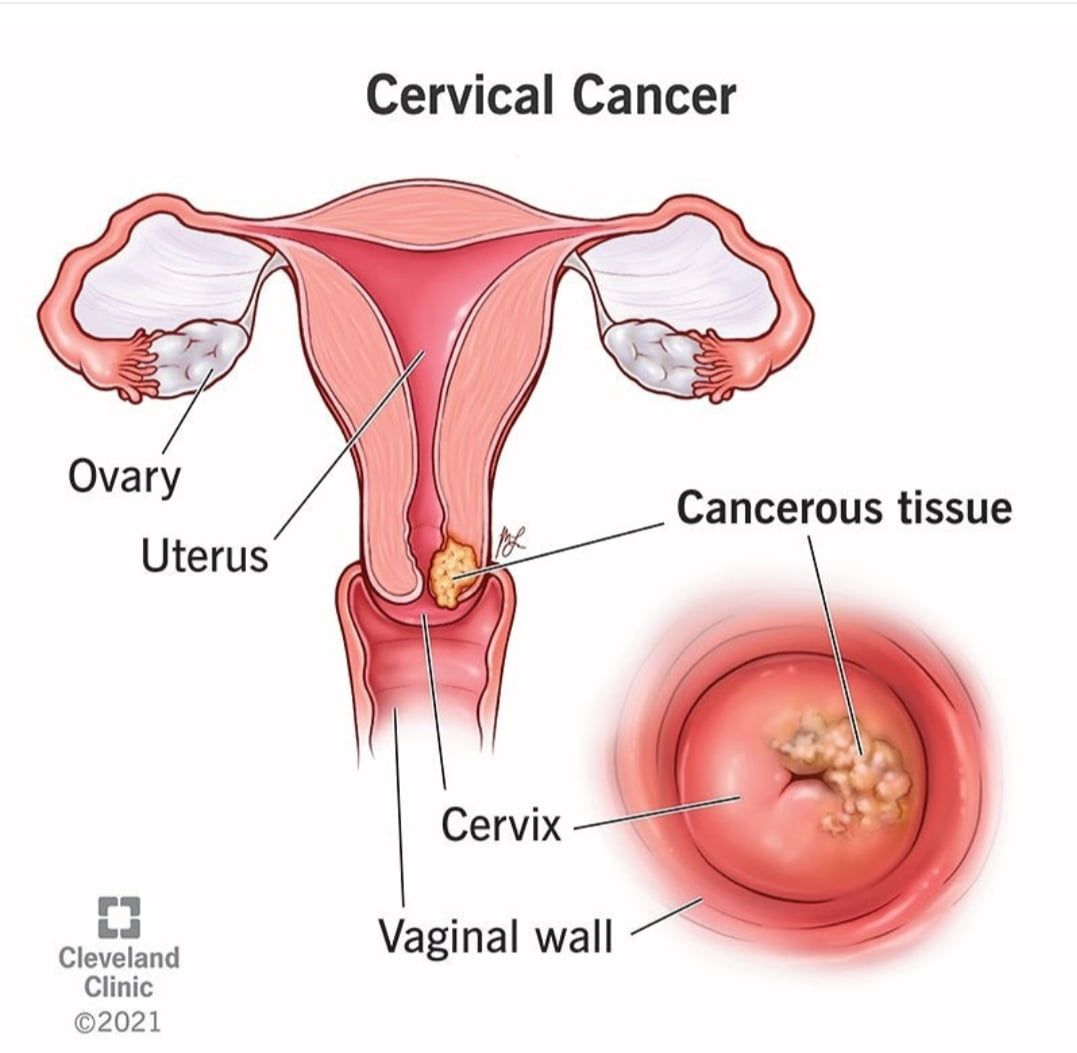 Cervical Cancer budget 2024